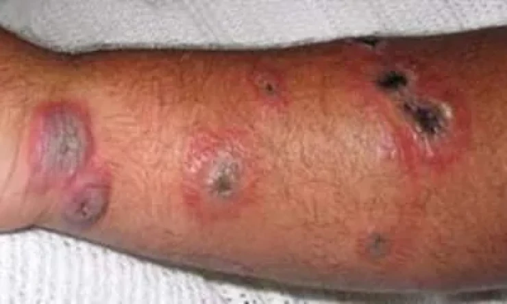 ŞARBON HASTALIĞI CAN ALDI